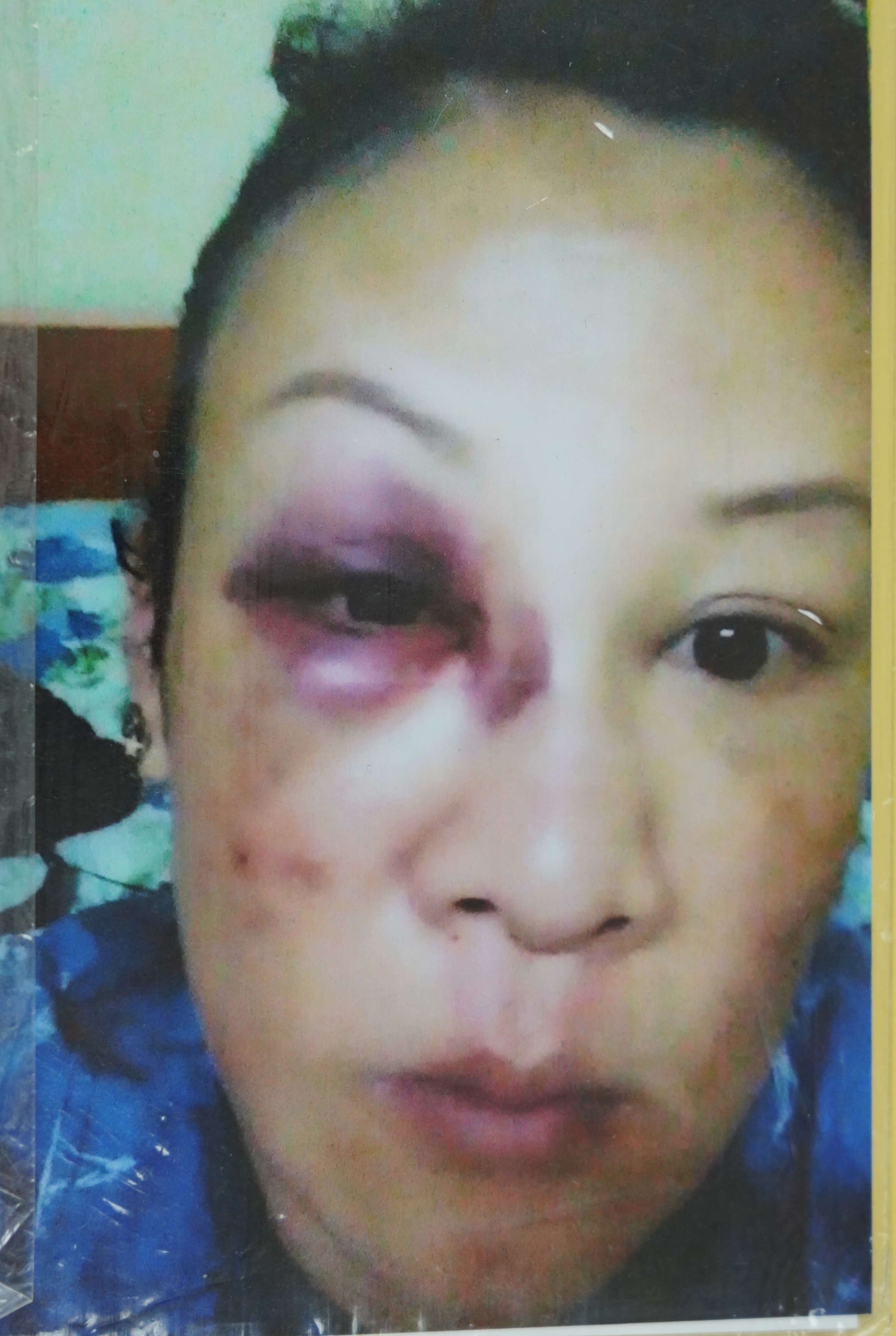 黄带群因不愿与缅甸男子同流合汙而被暴力对待,左耳及左眼更被殴打至失聪及眼角膜脱落。