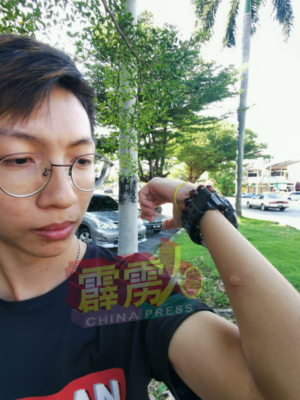 林晋升陪同前往打昔英德花园时被蚊子叮了几次红肿。