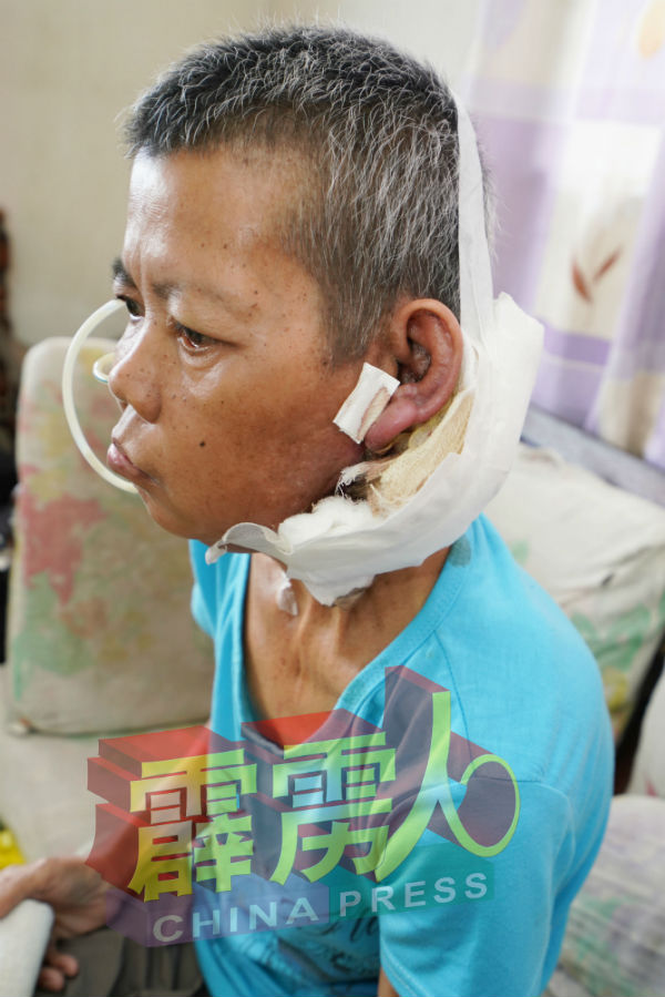 李金凤在去年时，发现自己的耳朵处长了一颗类似肿瘤的东西，经确诊后被证实患上癌症。