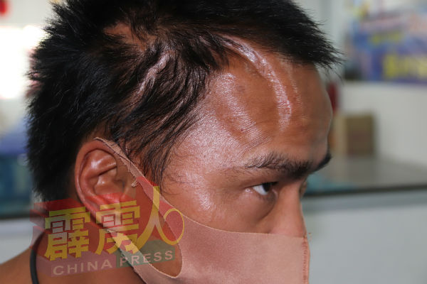 李进宝在2017年时，在半山芭一处天桥底下遭人打致头部重伤，如今头部留下很深的伤疤。