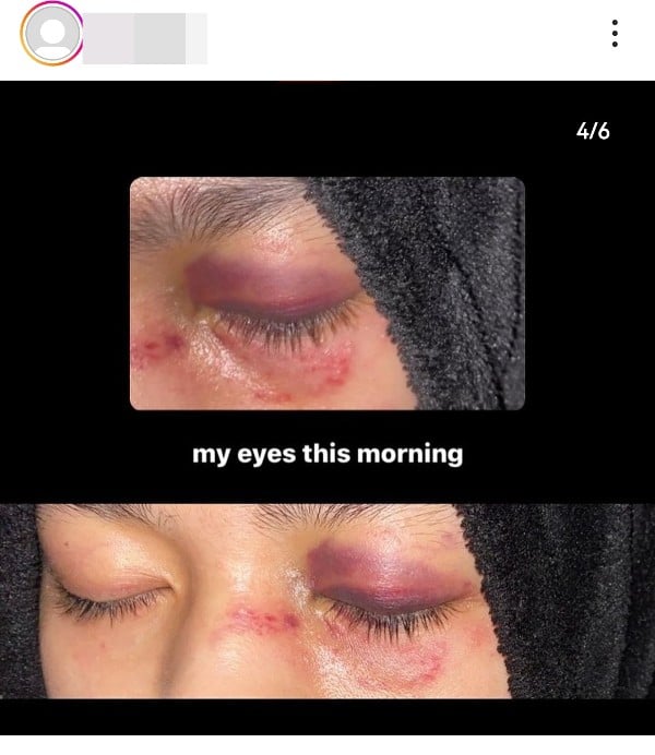 达莉雅眼睛红肿。（截图自达莉雅Instagram）