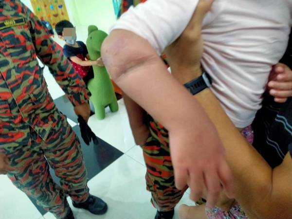 脱困后的女童右手臂凹陷，并送往医院接受治疗。