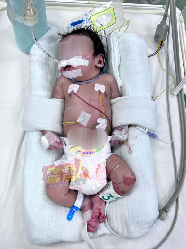 男婴呈现脱水现象，同时还出现呼吸急促问题，目前在新生儿重症监护室接受治疗。