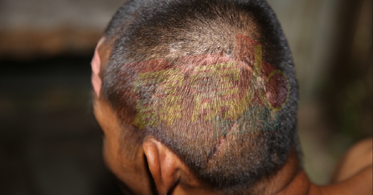 张志雄头部缝了十多针的伤痕，明显可见。