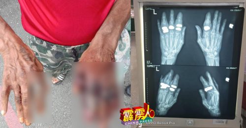 戒指太紧   手指溃烂