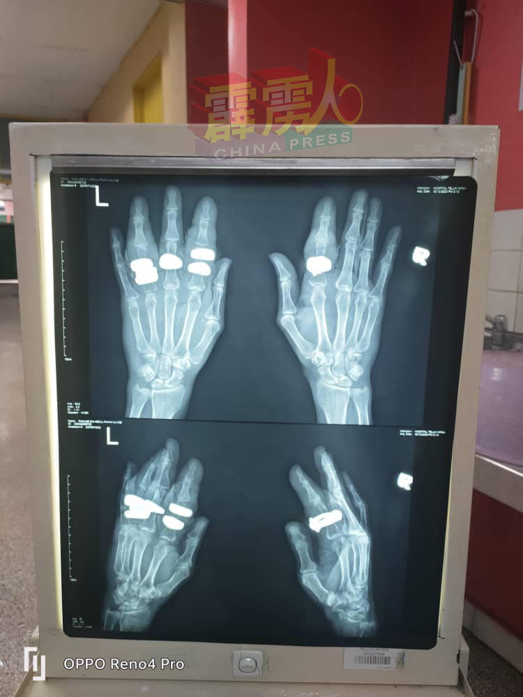 从X光片可见事主的手指已经肿胀。（安顺消拯局面子书）