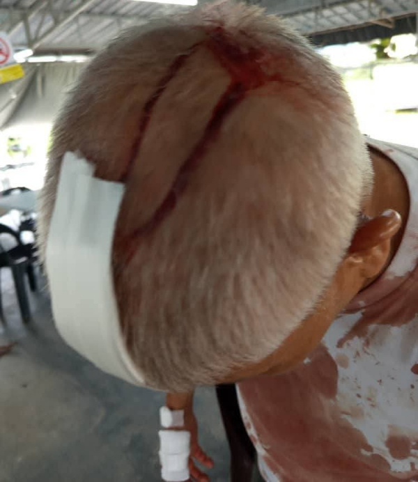 其中一名受害者头部受伤及缝针。